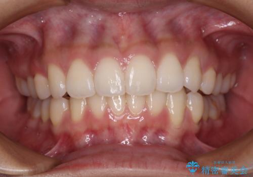 前歯のデコボコを解消 インビザラインの矯正治療