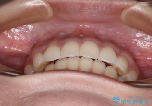 前歯のデコボコを解消 インビザラインの矯正治療の治療後