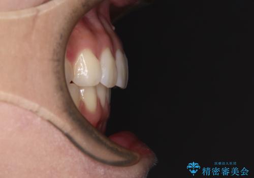 前歯のデコボコを解消 インビザラインの矯正治療の治療後