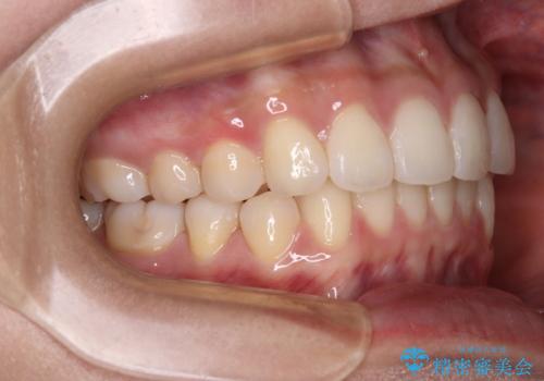 前歯のデコボコを解消 インビザラインの矯正治療の治療後