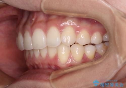 前歯のデコボコを解消 インビザラインの矯正治療の治療後