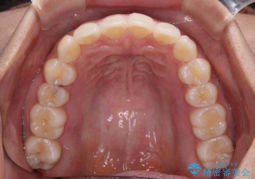 前歯のデコボコを解消　インビザラインの矯正治療の治療後