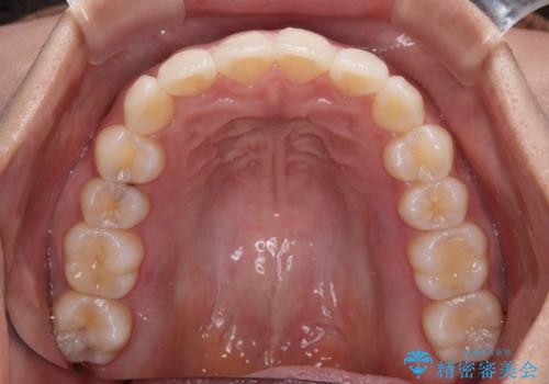 前歯のデコボコを解消 インビザラインの矯正治療の治療後