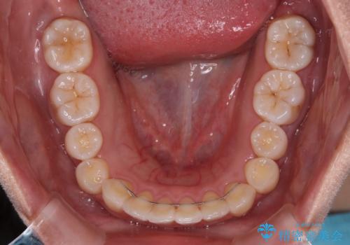 前歯のデコボコを解消 インビザラインの矯正治療の治療後