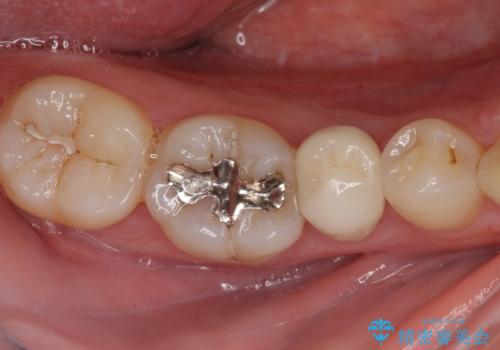 繰り返す痛み 下顎小臼歯の再根管治療の症例 治療後