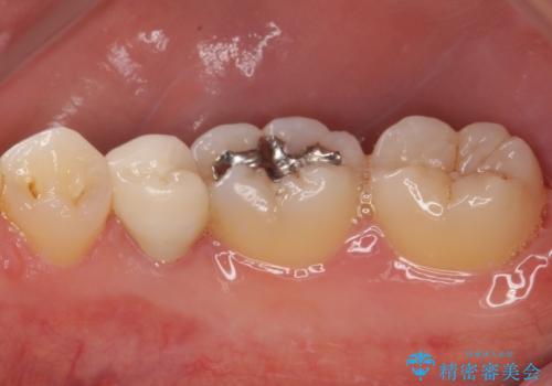 繰り返す痛み 下顎小臼歯の再根管治療の治療後