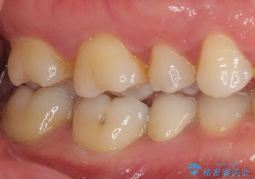 繰り返す痛み 下顎小臼歯の再根管治療の治療後