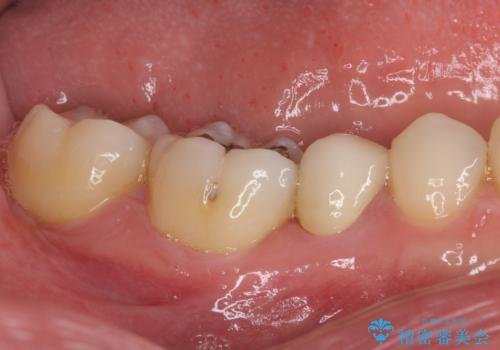 繰り返す痛み 下顎小臼歯の再根管治療の治療後