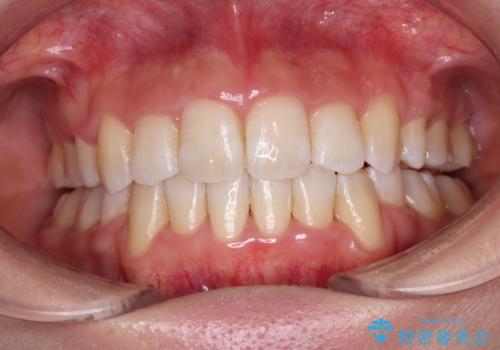 デコボコと出っ歯 抜歯矯正でスッキリとした口元にの症例 治療後