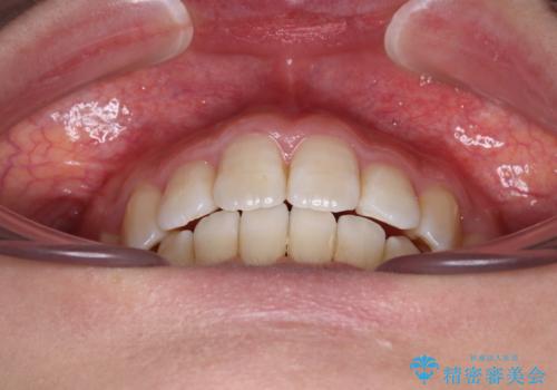 デコボコと出っ歯 抜歯矯正でスッキリとした口元にの治療後