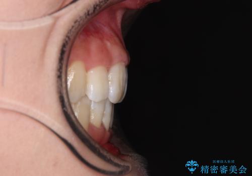 デコボコと出っ歯 抜歯矯正でスッキリとした口元にの治療後