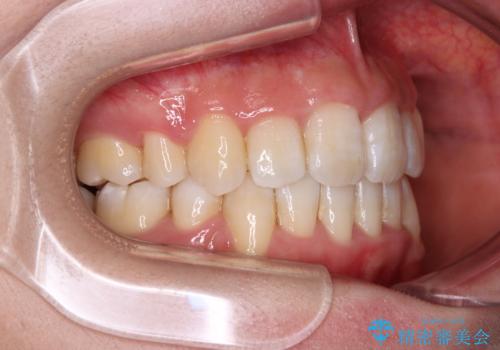 デコボコと出っ歯 抜歯矯正でスッキリとした口元にの治療後