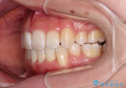 デコボコと出っ歯 抜歯矯正でスッキリとした口元にの治療後