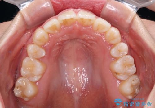 デコボコと出っ歯 抜歯矯正でスッキリとした口元にの治療後