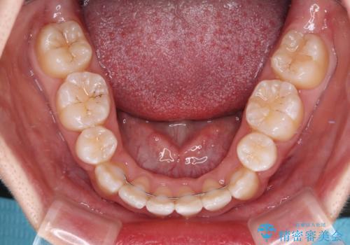 デコボコと出っ歯 抜歯矯正でスッキリとした口元にの治療後