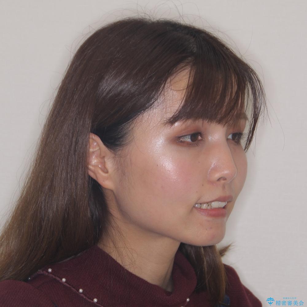 【モニター】上顎前突と奥歯の鋏状咬合 補助装置を用いたインビザライン矯正治療の治療前(顔貌)