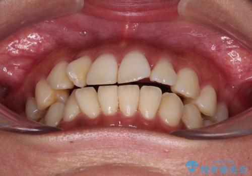 【モニター】上顎前突と奥歯の鋏状咬合 補助装置を用いたインビザライン矯正治療の治療前