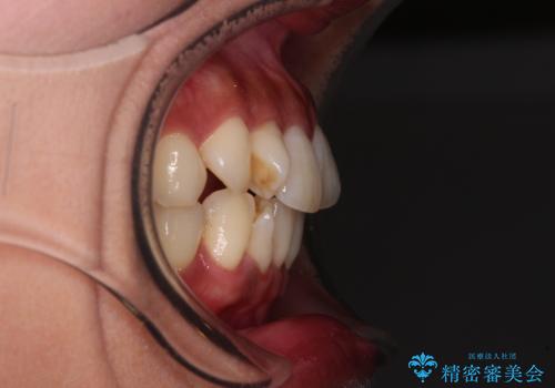 【モニター】上顎前突と奥歯の鋏状咬合 補助装置を用いたインビザライン矯正治療の治療前