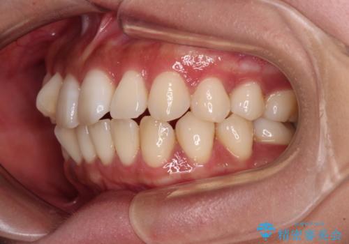 【モニター】上顎前突と奥歯の鋏状咬合 補助装置を用いたインビザライン矯正治療の治療前