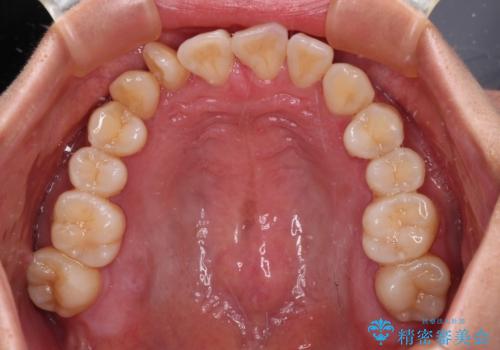 【モニター】上顎前突と奥歯の鋏状咬合 補助装置を用いたインビザライン矯正治療の治療前