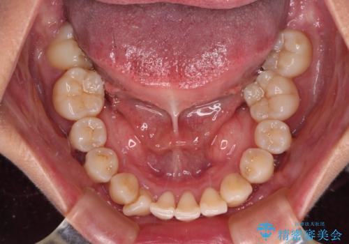 【モニター】上顎前突と奥歯の鋏状咬合 補助装置を用いたインビザライン矯正治療の治療前
