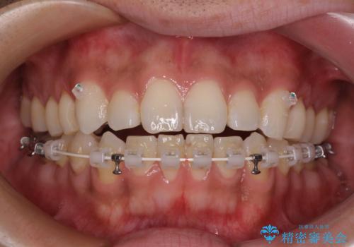 目立たない装置でデコボコを改善　ハーフリンガルによる矯正治療の治療中