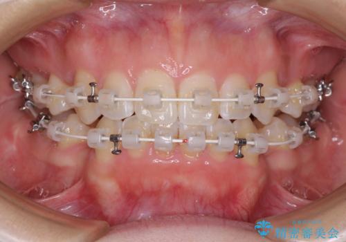 閉じにくい口元をワイヤー抜歯矯正でスッキリ改善の治療中