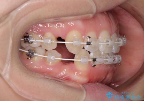 閉じにくい口元をワイヤー抜歯矯正でスッキリ改善の治療中