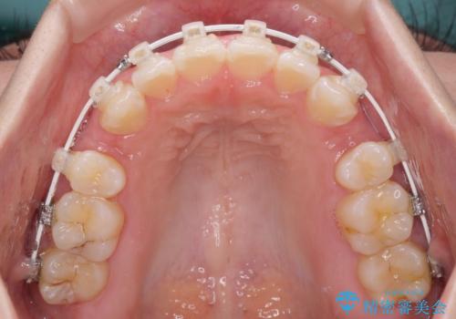 閉じにくい口元をワイヤー抜歯矯正でスッキリ改善の治療中