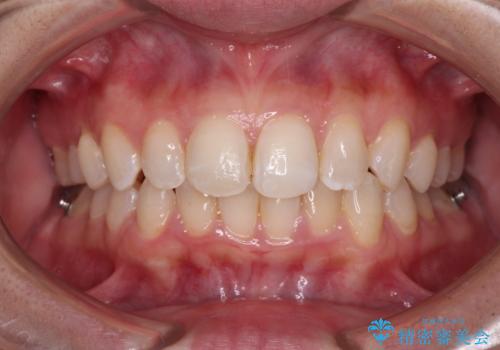 埋もれた奥歯をワイヤーで改善 インビザラインによる矯正治療の治療中