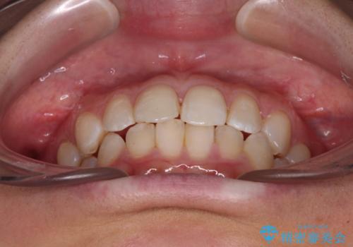 埋もれた奥歯をワイヤーで改善 インビザラインによる矯正治療の治療中