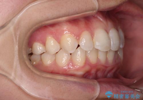 埋もれた奥歯をワイヤーで改善 インビザラインによる矯正治療の治療中