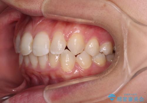 埋もれた奥歯をワイヤーで改善 インビザラインによる矯正治療の治療中