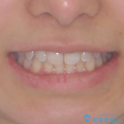 埋もれた奥歯をワイヤーで改善 インビザラインによる矯正治療の治療前(顔貌)