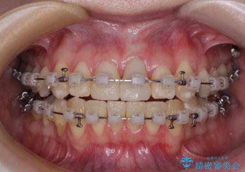 気になる前歯 ワイヤー矯正とセラミック治療の治療中