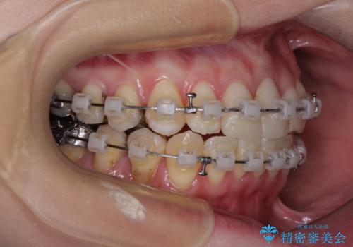 気になる前歯 ワイヤー矯正とセラミック治療の治療中