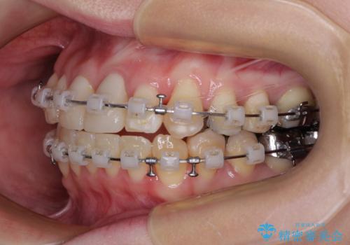 気になる前歯　ワイヤー矯正とセラミック治療の治療中