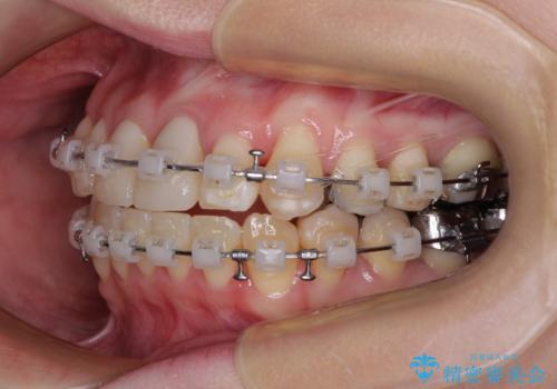 気になる前歯 ワイヤー矯正とセラミック治療の治療中