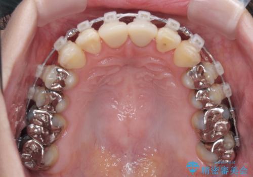 気になる前歯 ワイヤー矯正とセラミック治療の治療中