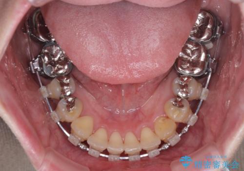 気になる前歯 ワイヤー矯正とセラミック治療の治療中