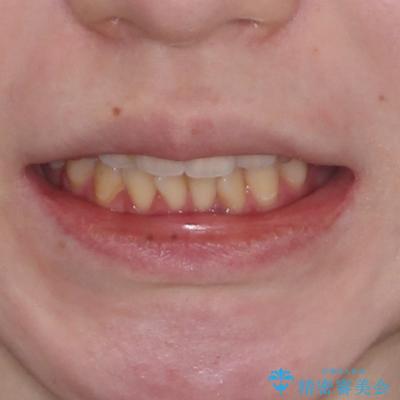 開咬と前方に飛び出した前歯 インビザラインによる矯正治療の治療前(顔貌)