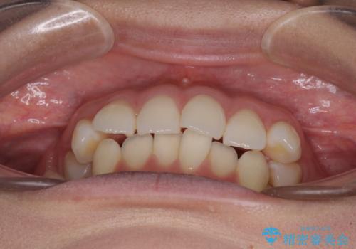 前歯のデコボコを解消 インビザラインの矯正治療の治療前