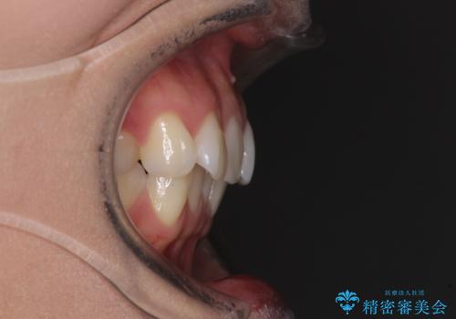 前歯のデコボコを解消 インビザラインの矯正治療の治療前