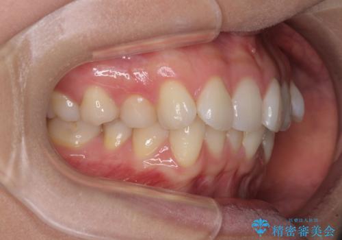 前歯のデコボコを解消 インビザラインの矯正治療の治療前
