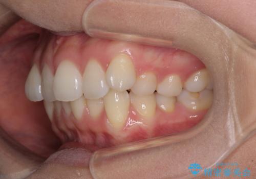 前歯のデコボコを解消 インビザラインの矯正治療の治療前