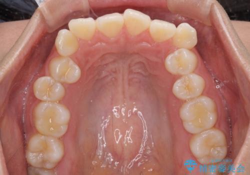 前歯のデコボコを解消　インビザラインの矯正治療の治療前