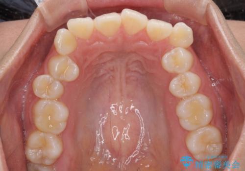 前歯のデコボコを解消 インビザラインの矯正治療の治療前