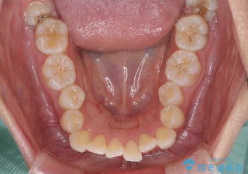 前歯のデコボコを解消 インビザラインの矯正治療の治療前