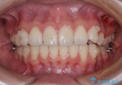 前歯のデコボコを解消 インビザラインの矯正治療の治療中
