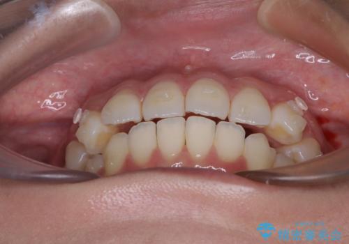 前歯のデコボコを解消 インビザラインの矯正治療の治療中